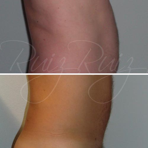 liposuction before and after malaga