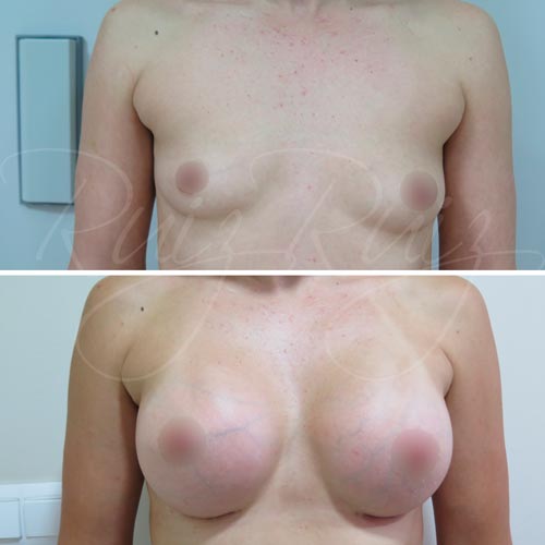 breast enlargement doctor malaga