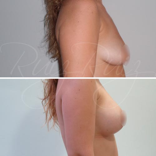 breast reconstruction photos malaga