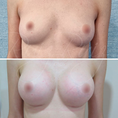 breast enlargement malaga