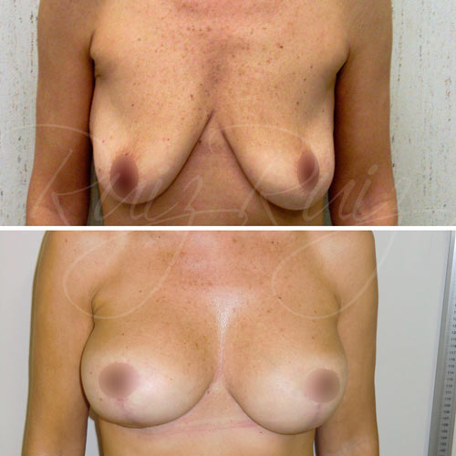 breast lift scars 3 weeks