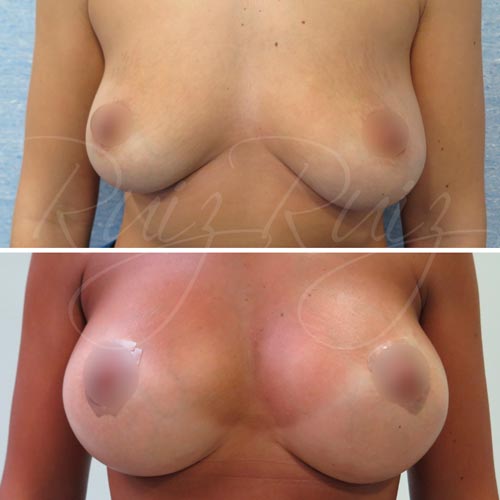 healed one year breast lift scars