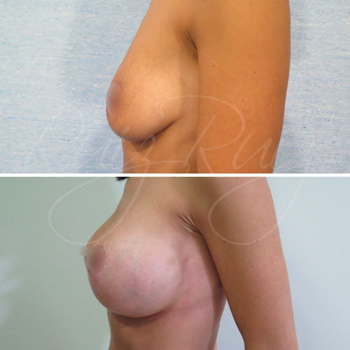 breast lift with implants malaga