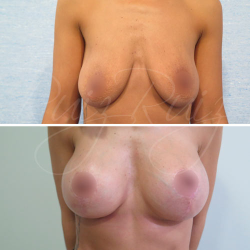 breast lift without breast implants malaga