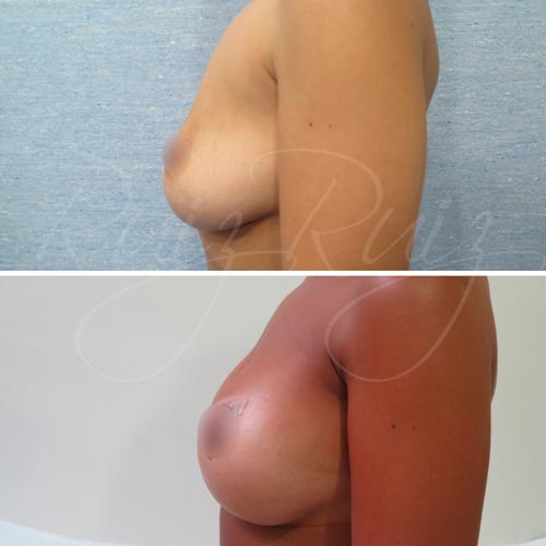 breast lift before after malaga