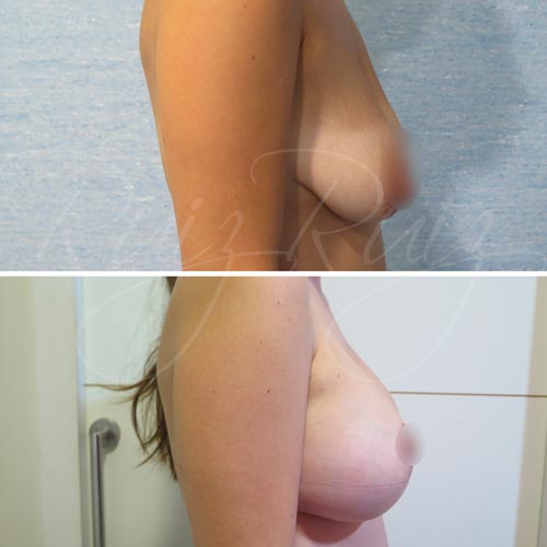 breast lift surgery malaga