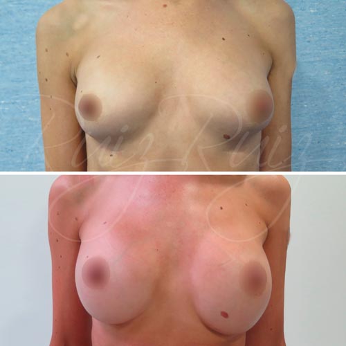 breast reconstruction surgery after mastectomy malaga