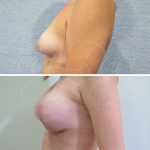 breast reconstruction surgery options malaga