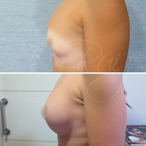 breast implant removal and reconstruction malaga