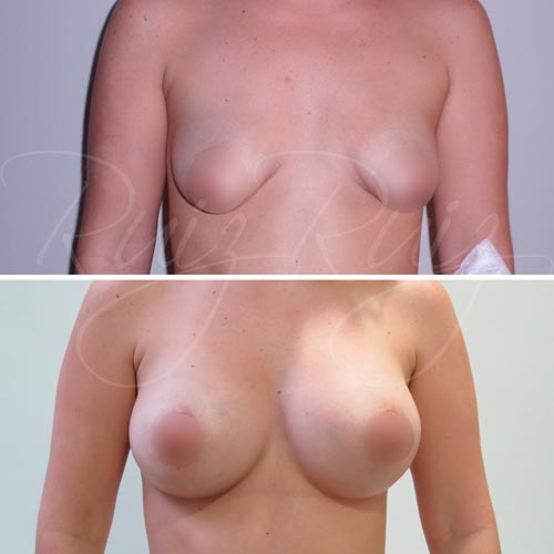 female breast reconstruction surgeon malaga