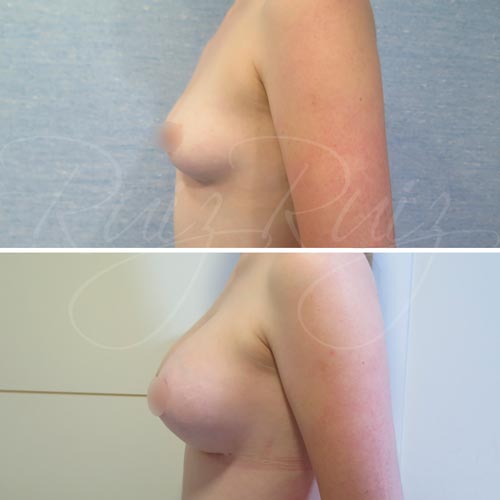 direct to implant breast reconstruction malaga