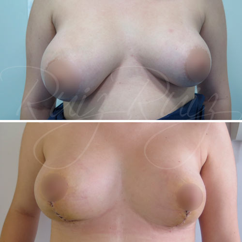 breast reconstruction images malaga