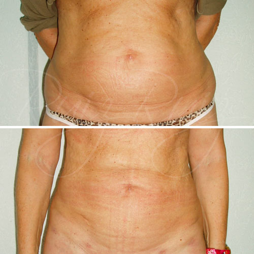 liposuction abdomen malaga