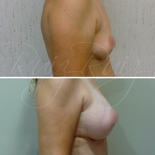 best breast reconstruction surgeons in malaga