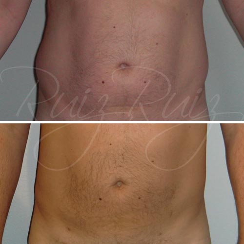 liposuction before and after men malaga