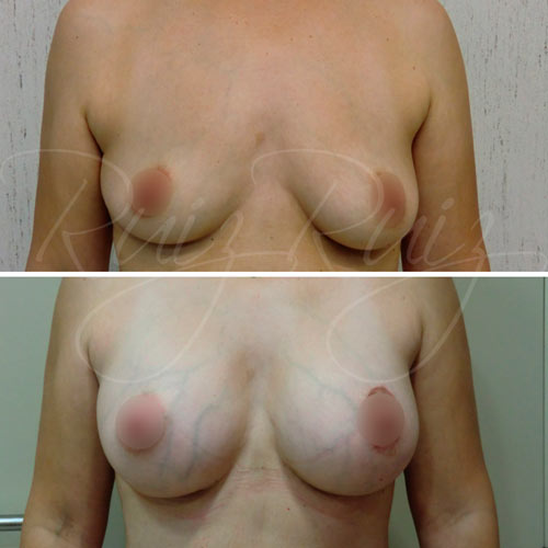 breast reconstruction implants malaga