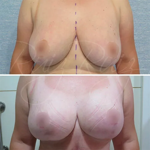 breast implant removal and replacement prices malaga