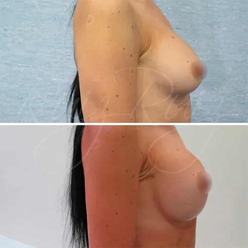breast implant replacement cost malaga