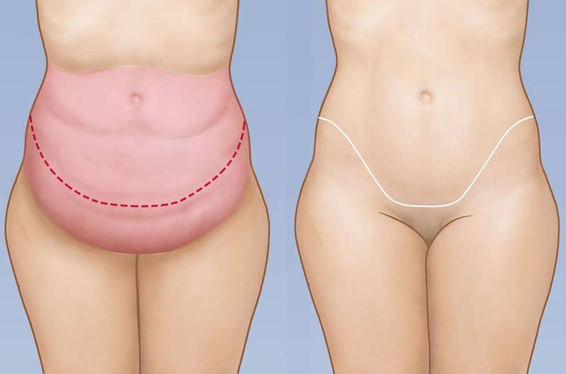 how tummy tuck is done