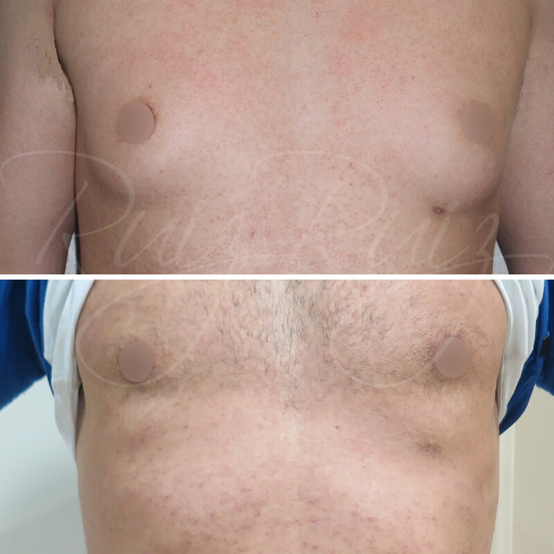 before-and-after-gynecomastia-1
