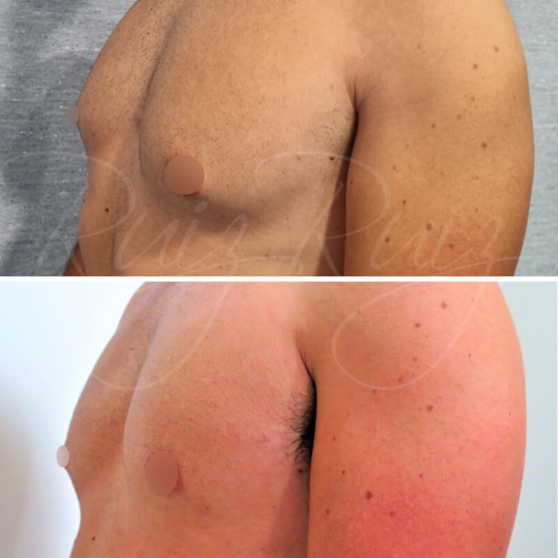 gynecomastias-before-after-2