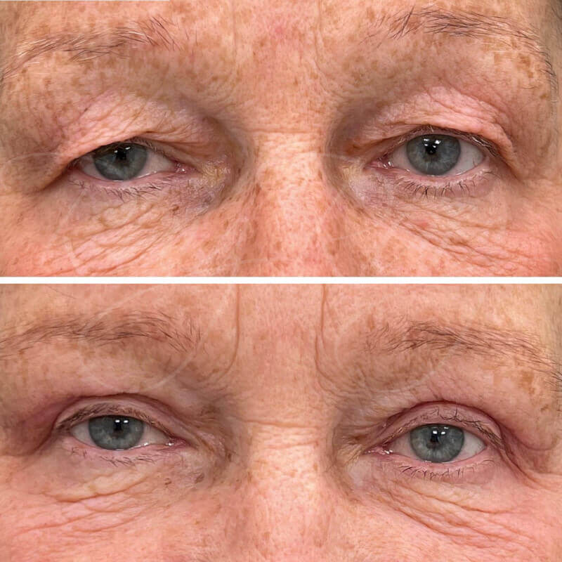 results-eyelid-surgery-2