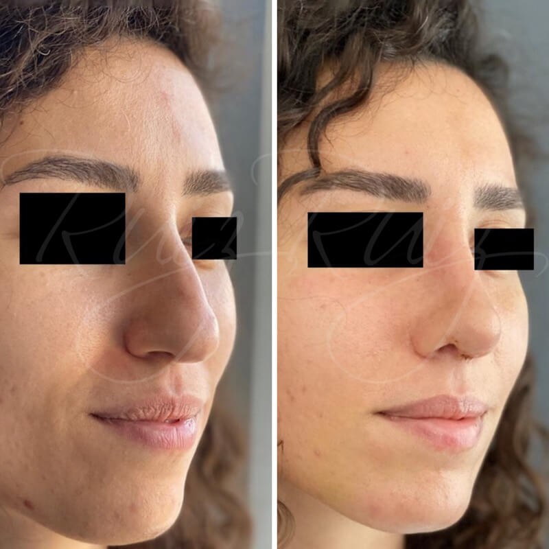 results-nose-surgery-1