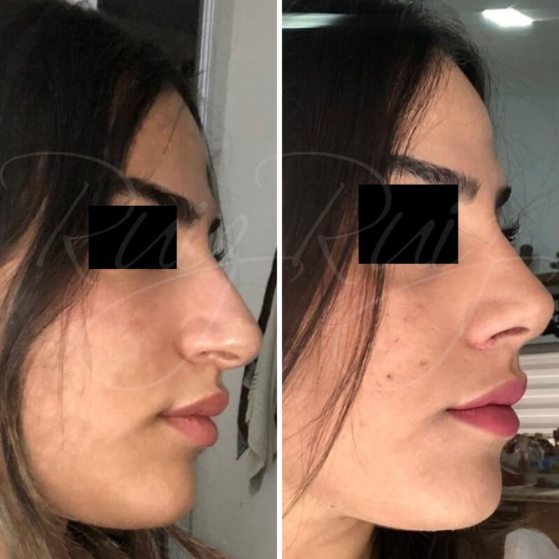 results-nose-surgery-2