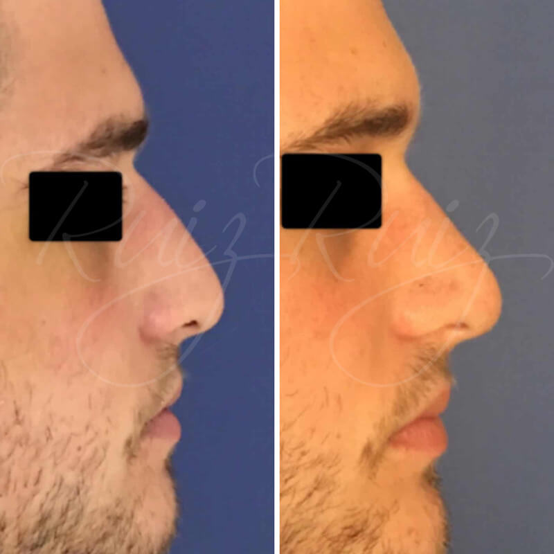 results-nose-surgery-3
