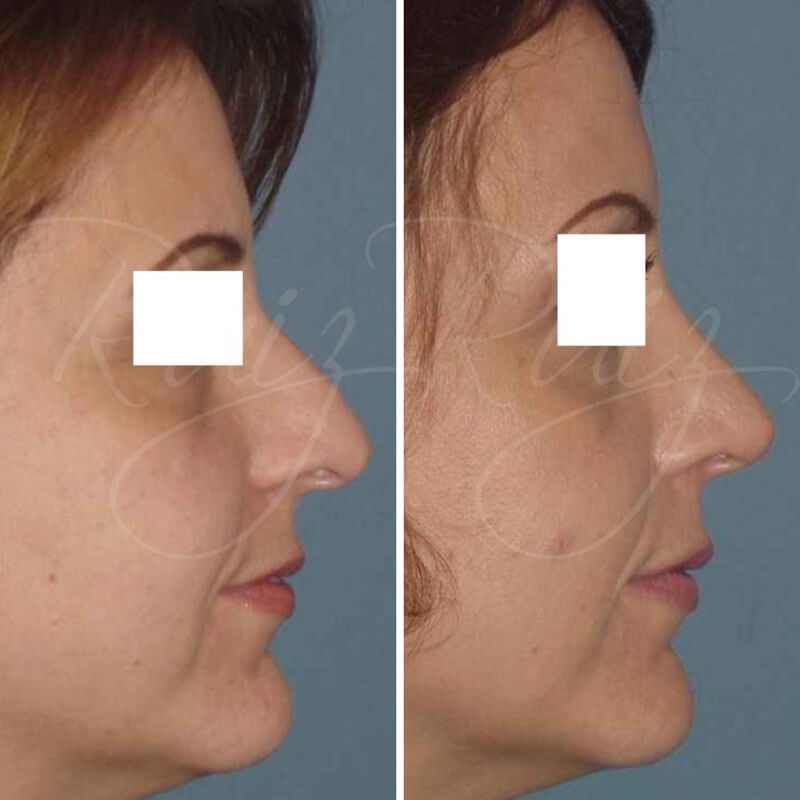 results-nose-surgery-4