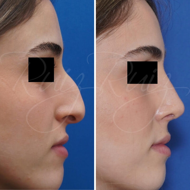 results-nose-surgery-5