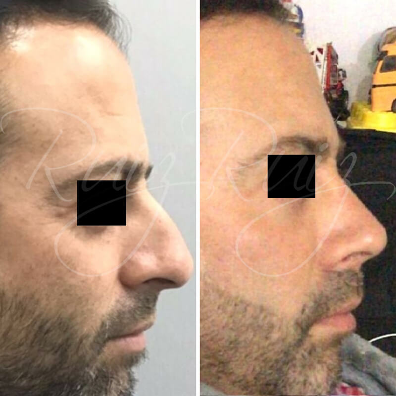 results-nose-surgery-6
