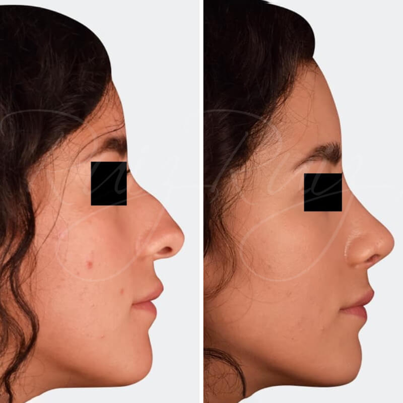 results-nose-surgery-7