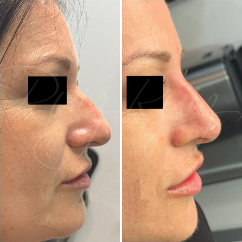 results-nose-surgery-8