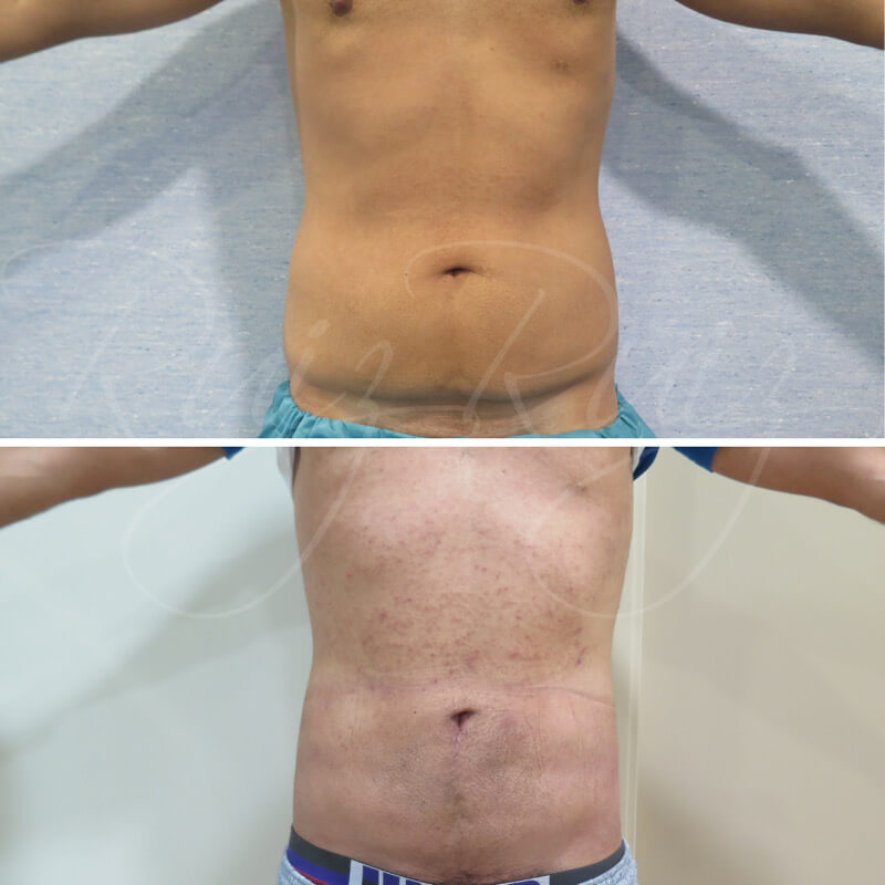 results-of-liposuction-2