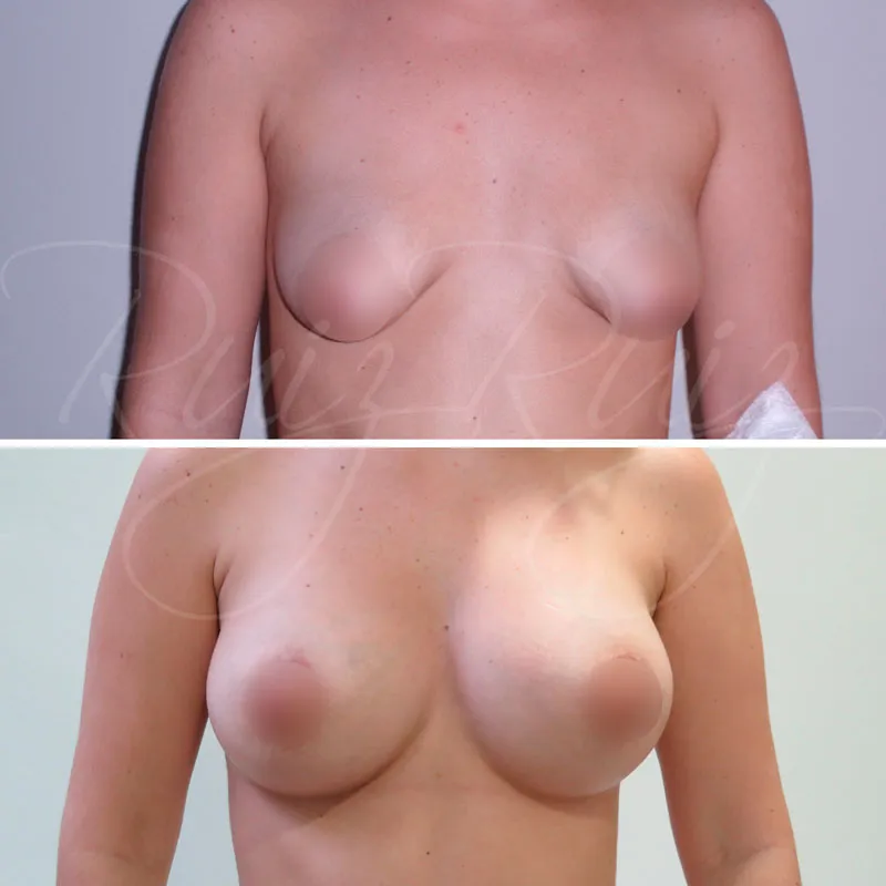 before and after tuberous breasts in malaga