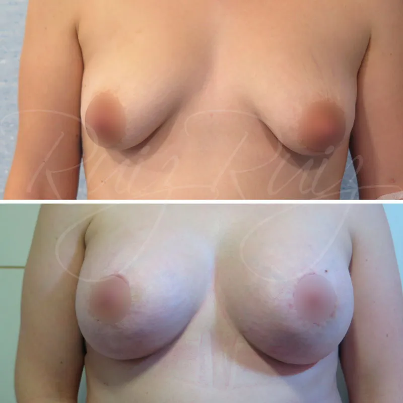 results of tuberous breast surgery in malaga